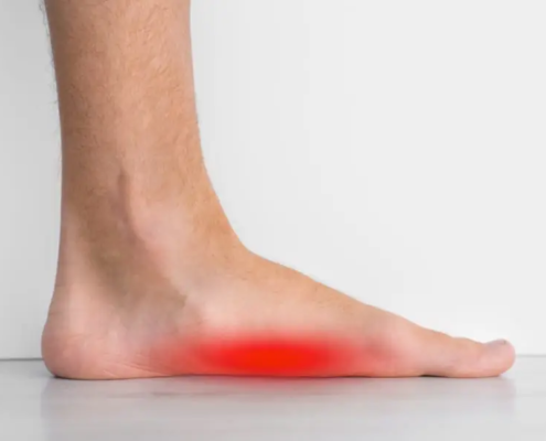 hielspoor peesplaatontsteking - Voetencentrum Flipse